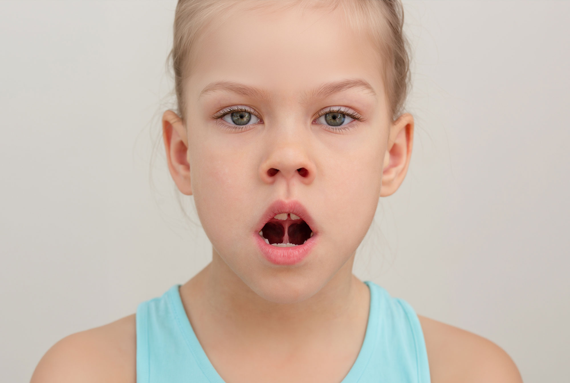 Zungenband, orale Restriktion, Behandlung, Frenotomie